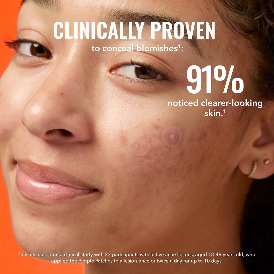 pimple-patches-t1 zb_p.jpg